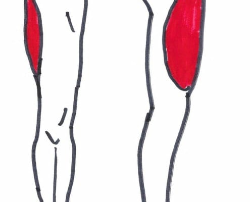 Meralgia ParästheticaKlinik for Osteopati og Akupunktur i Kolding