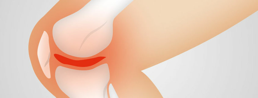 Lægemedicinsk osteopati: kirurger, fingrene væk fra menisken! Klinik Gahlenbeck i Kolding