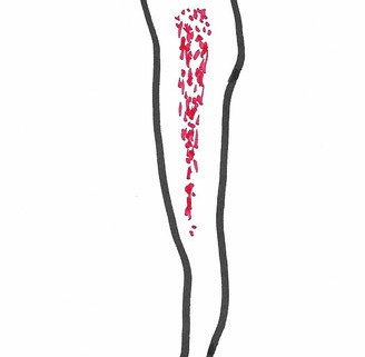 pseudobursitis trochanterica Sundhedstips fra Klinik Gahlenbeck, Lægeklinik for osteopati og Akupunktur i Kolding.