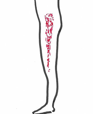 pseudobursitis trochanterica Sundhedstips fra Klinik Gahlenbeck, Lægeklinik for osteopati og Akupunktur i Kolding.