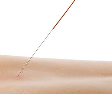  15 spændende spørgsmål om akupunktur Information fra Klinik Gahlenbeck, Lægeklinik for osteopati og Akupunktur i Kolding.