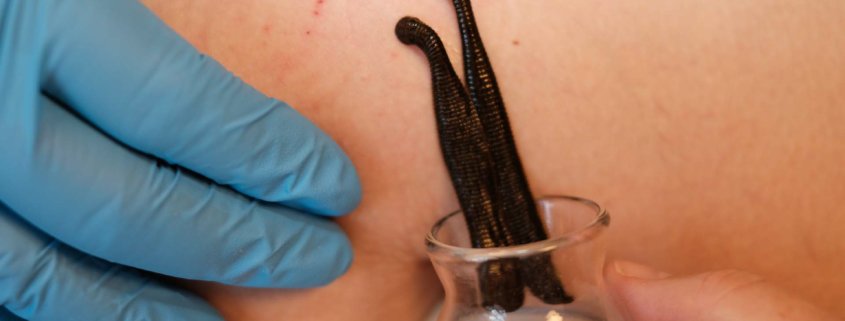 Information fra Klinik Gahlenbeck, Lægeklinik for osteopati og Akupunktur i Kolding. Ækeligt eller genialt? Helbredelse med maddiker, igler