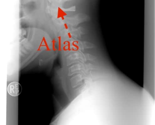 Atlas terapi efter Arlen, hvad er det? Hvor kan det hjælpe? Sundhedstips fra Klinik Gahlenbeck, Lægeklinik for osteopati og Akupunktur i Kolding.