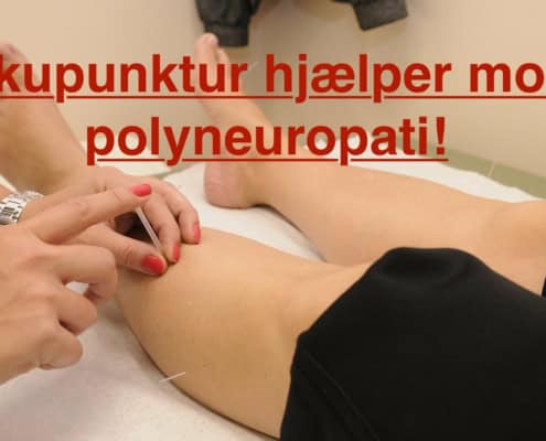 Akupunktur kan hjælper mod polyneropayti! Klinik Gahlenbeck i Kolding