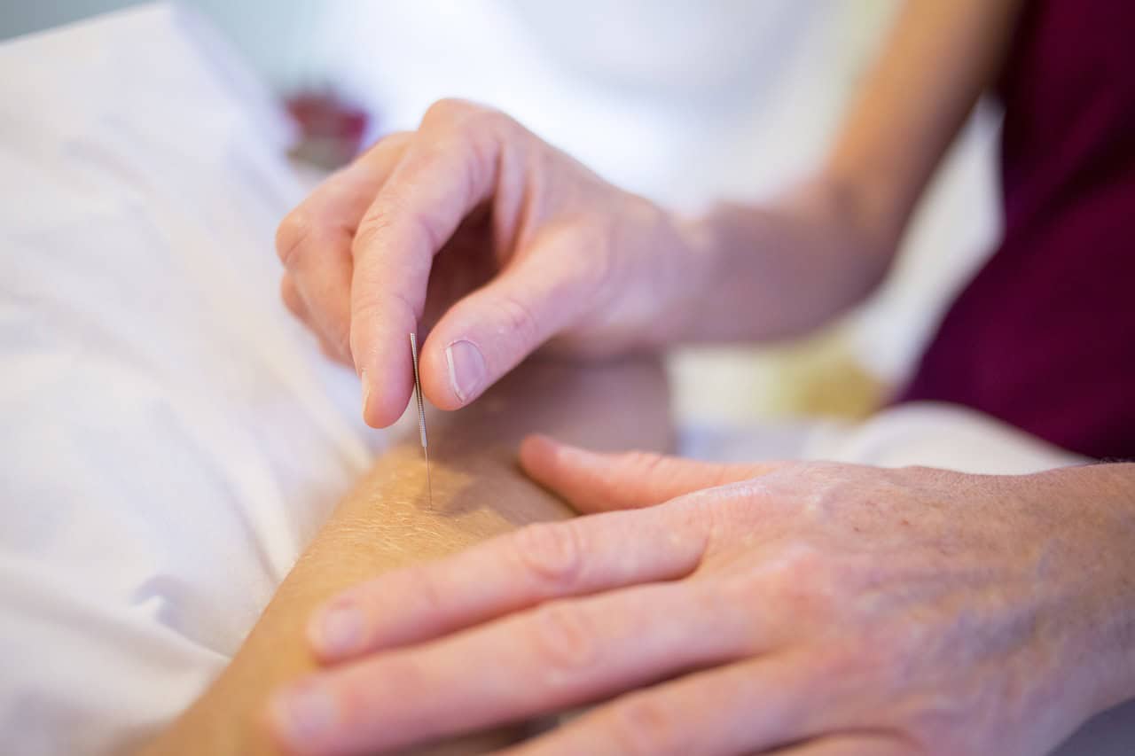 acupuncture 5126777 1280