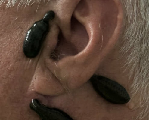 Igler mod tinnitus